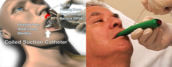 nasal suctioning with the no-bite v