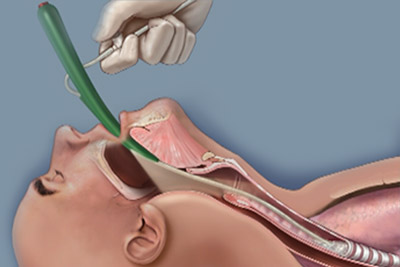 oral suctioning